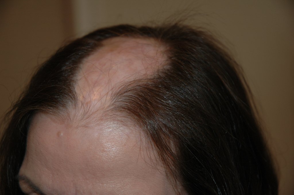 Scarring Alopecia Aderans Hair Centre